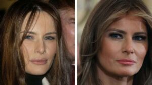 Melania-Trump-Before-and-After-Plastic-Surgery-Journey.jpg