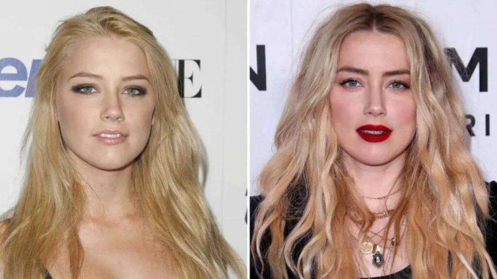 Amber-Heard-Before-and-After-Plastic-Surgery-Journey.jpg