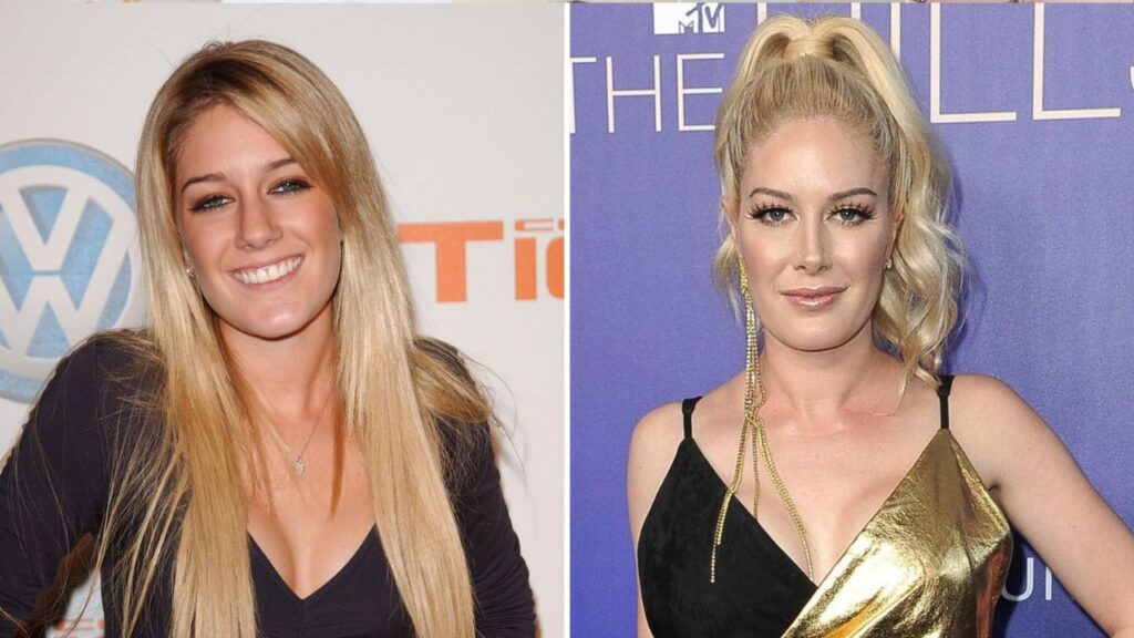 Heidi-Montag-Before-and-After-Plastic-Surgery-Journey.jpg