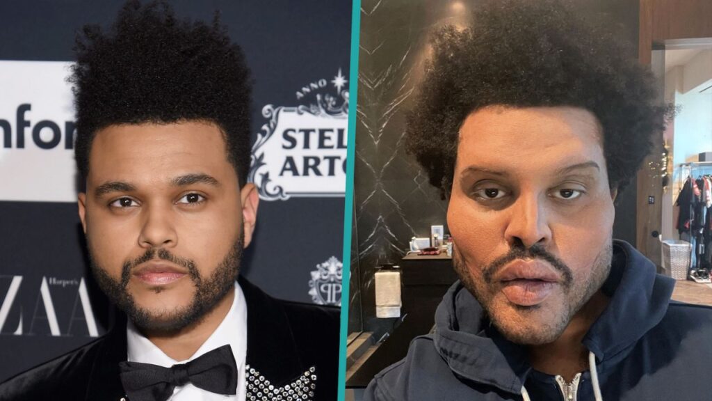The-Weeknd-Before-and-After-Plastic-Surgery-Journey.jpg